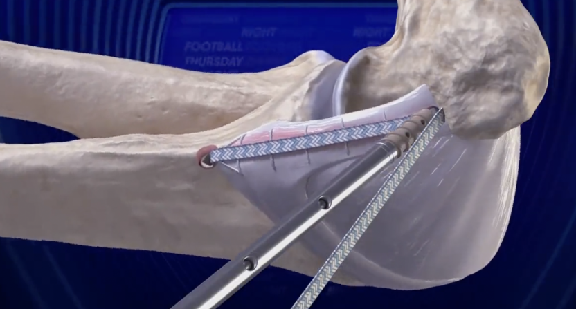 Amazon Prime Video Brock Purdy surgery animation